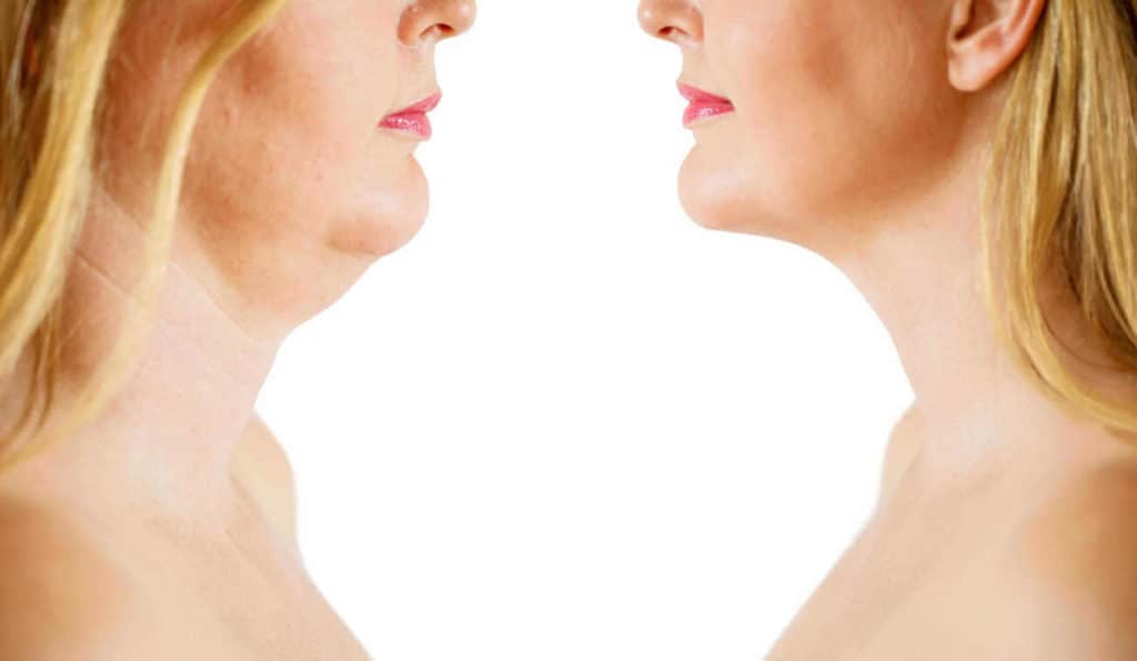 Double Chin treatment Yeading before and after results