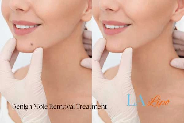 woman's before and after mole removal Yeading results
