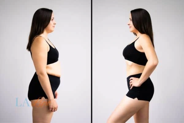 image of woman before and after results of LA-EMS Body Sculpting Yeading to help treat Diastasis recti