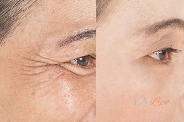 Before and after results of woman - HI-fu wrinkles reduction treatment Yeading