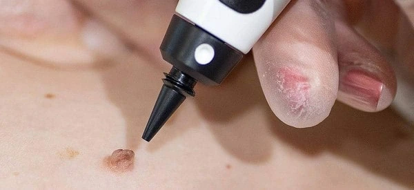 skin tag removal using cryopen Yeading