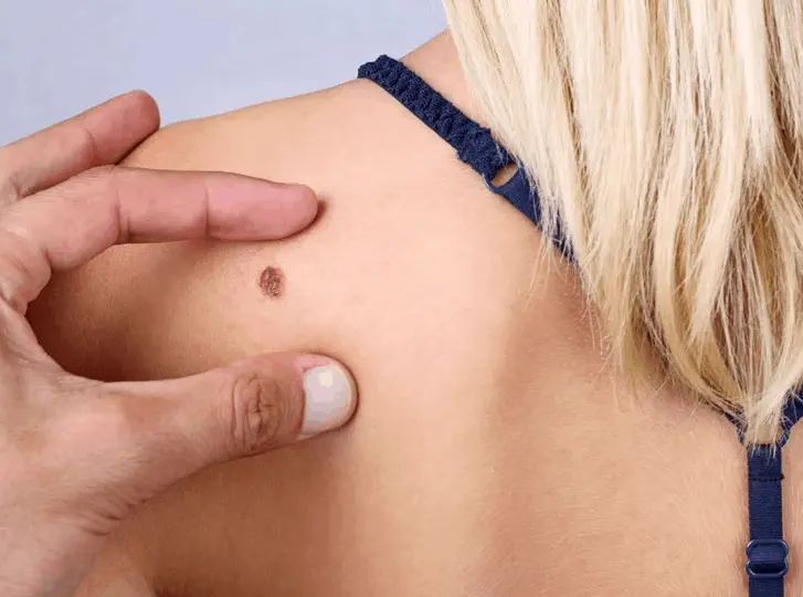 woman having mole removal Yeading consultation before treatment.