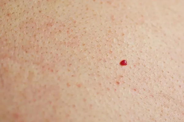close up of a cherry angioma Yeading