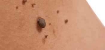 image of a skin tag Yeading
