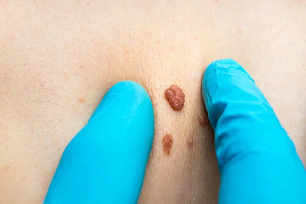 Consultant examining a skin tag Yeading