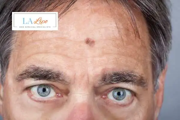 Solar Lentigo Removal Yeading image of man with mark on his forehead