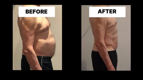 What Symptoms Can Diastasis Recti Cause in Men? Weak Core, Back Pain and Poor Posture Yeading